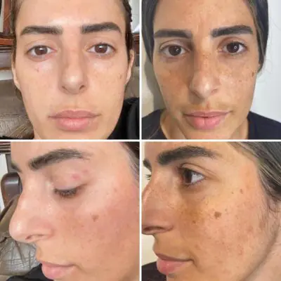 נטלי סקין בוטיק-טיפולי פנים מתקדמים - טיפול בפיגמנטציה בפילינג