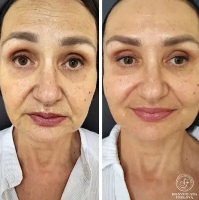 ד"ר סבטלנה פרולובה - הצערת פנים ללא הזרקת חומצה היאלורונית