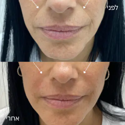 ד"ר יאיר יוסף - רפואה אסתטית מתקדמת - מילוי קמטי נזולביאל 
