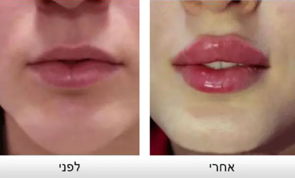 ד"ר לי יון - עיצוב שפתיים בחומצה היאלורונית