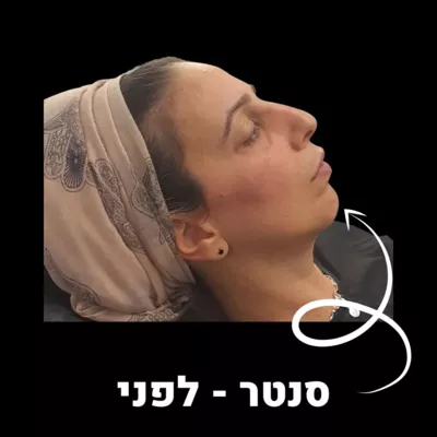 עיצוב סנטר באמצעות הזרקות -  ד''ר טל