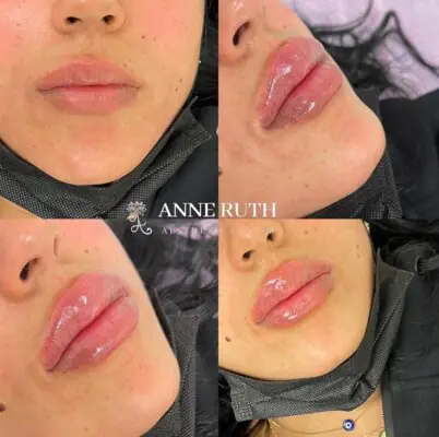 אן רות אסתטיקה - עיצוב שפתיים בחומצה היאלורונית