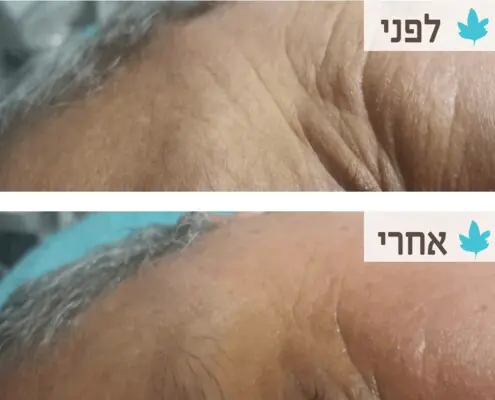 עורגני קליניקה לרפואה אסתטית - טיפול בקמטים ברדיו