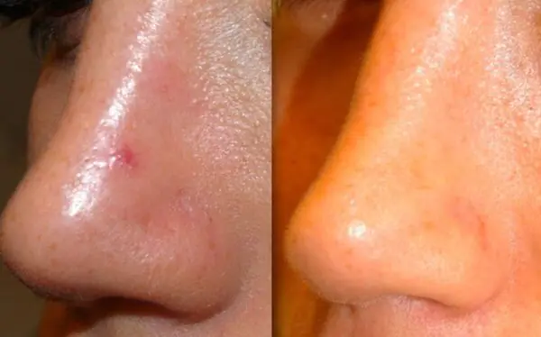 לייזר פרו - העלמת נימים בולטים באף בלייזר