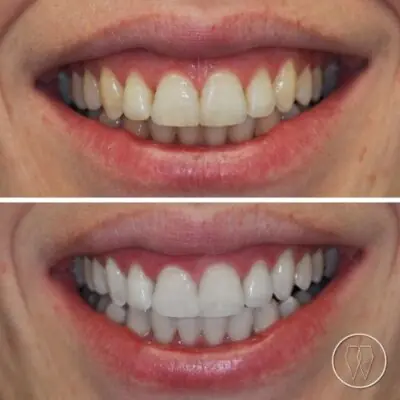 הלבנת שיניים במרפאה - ד״ר עומרי קראוס