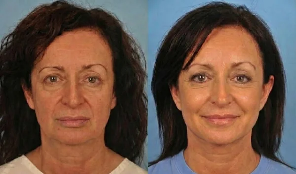 מתיחת פנים למראה מושלם -  ד"ר בעז אמן מומחה לכירורגיה פלסטית בראשון  לציון