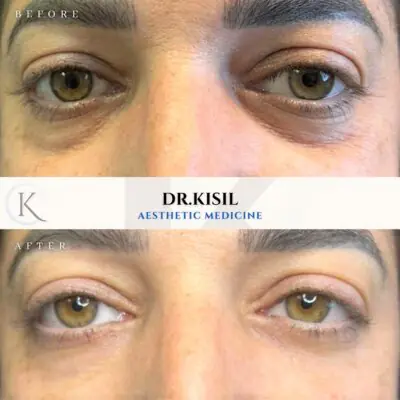 ד"ר קיסיל קטרין - ניתוח עפעפיים תחתונים ושקיות מתחת לעיניים