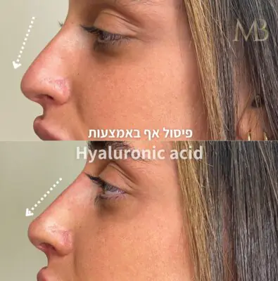 פיסול אף - MBcosmetic