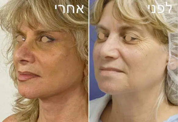 ד"ר אייל שפירא - ניתוח הרמת עפעפיים