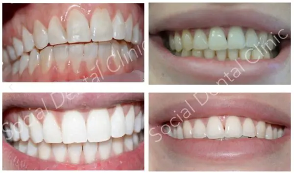 הלבנת שיניים במרפאה - הקליניקה החברתית לרפואת שיניים