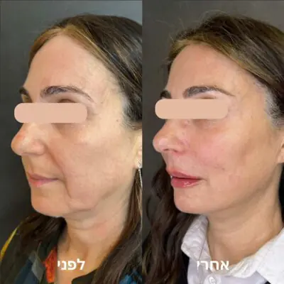 ד"ר משה רוזן - פיסול פנים ומילוי קמטים