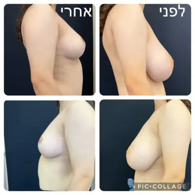 ד״ר נגה גולדמן - ניתוח הקטנת חזה