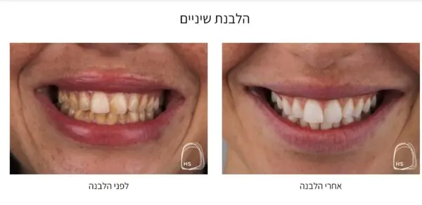 הלבנת שיניים במרפאה - הכט סמייל בהנהלת ד&quot;ר אילן הכט