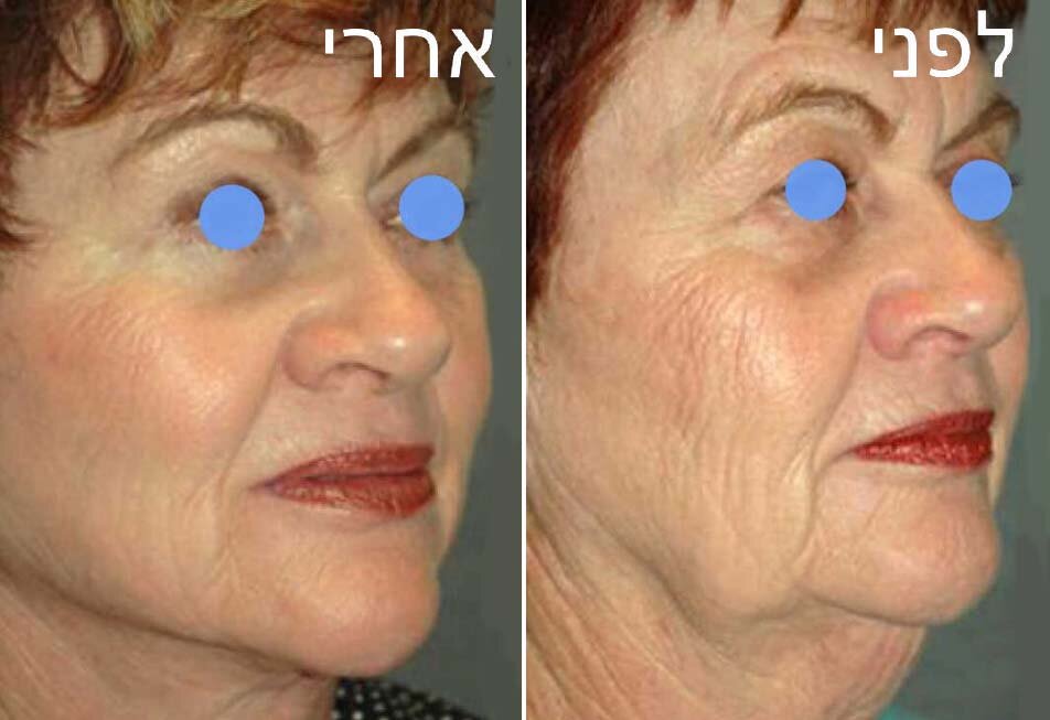 ד&quot;ר אייל שפירא - ניתוח מתיחת פנים