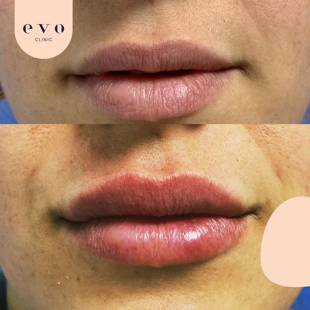 EVO CLINIC - עיצוב שפתיים בחומצה היאלורונית