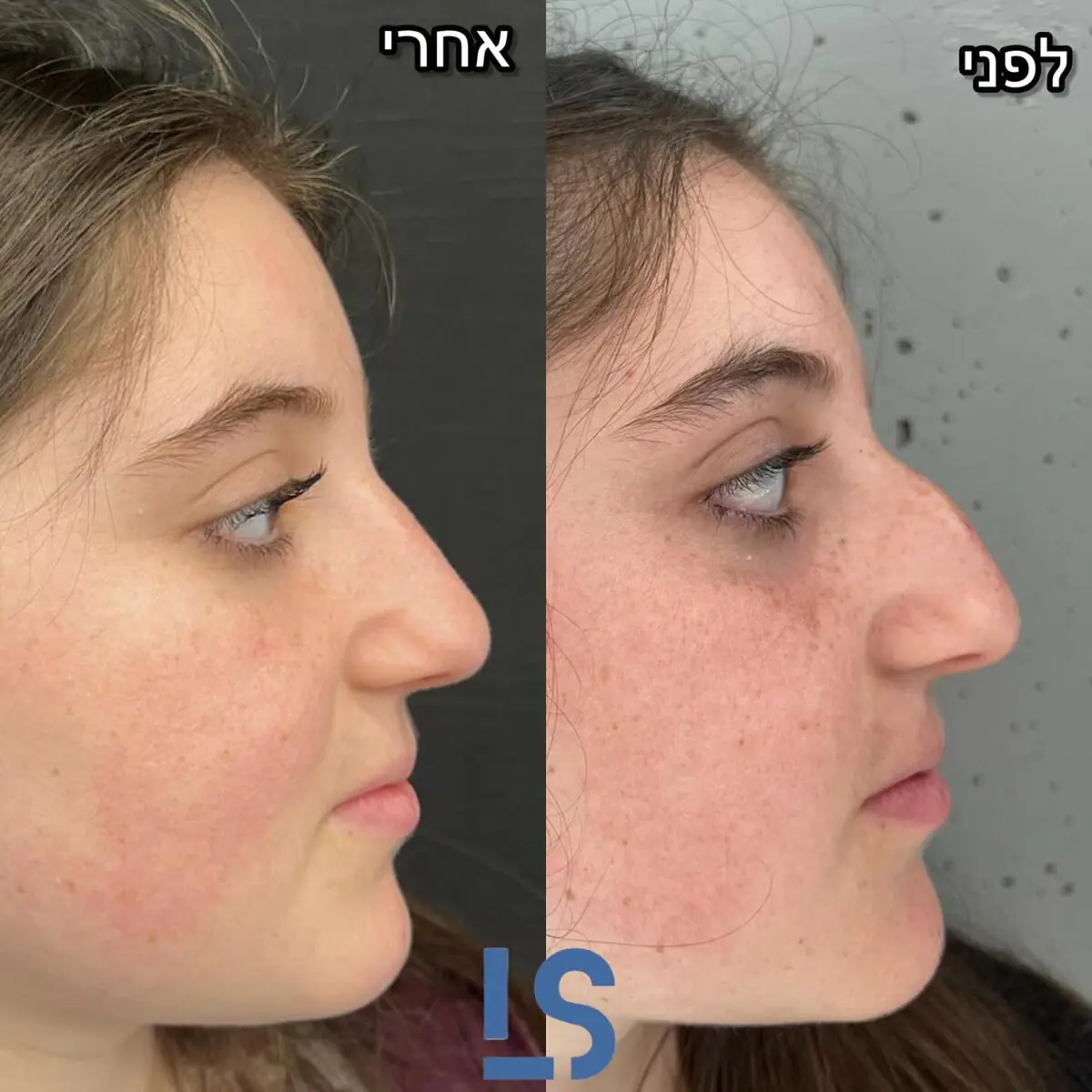 ד"ר ליהי שגיא - טיפולי בוטוקס