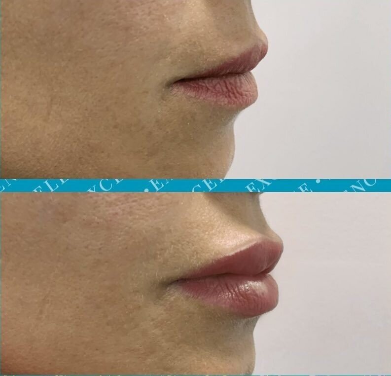 Excellence Clinic ד&quot;ר טל נחליאלי - עיצוב ועיבוי שפתיים בחומצה היאלורונית
