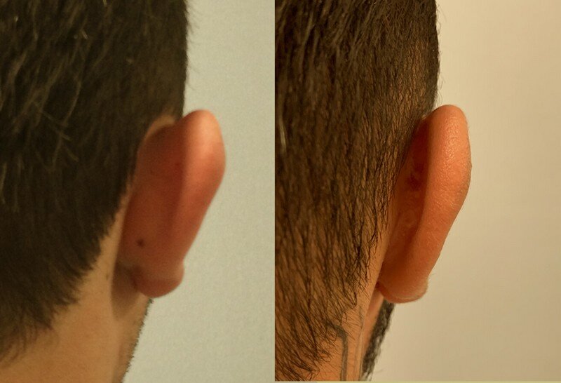 ד"ר ערן חדד - ניתוח להצמדת אוזניים